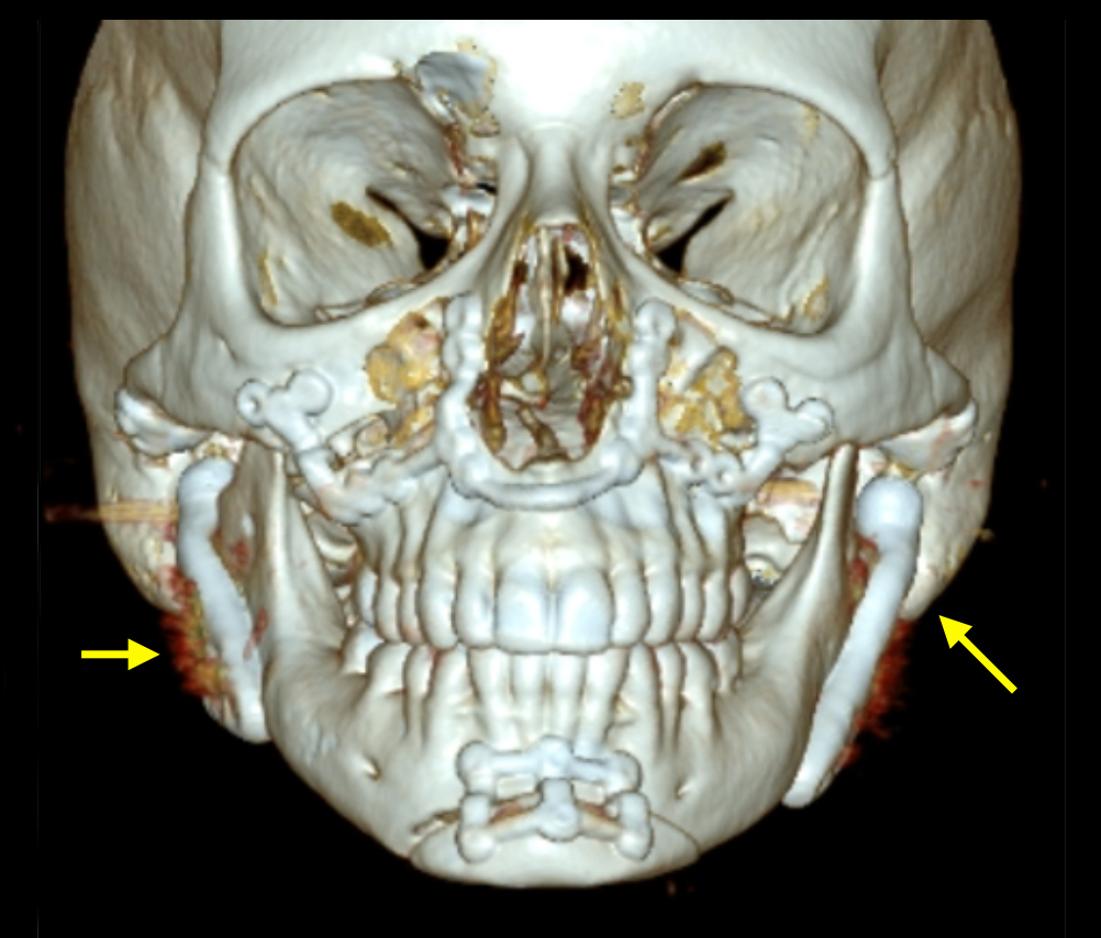 Post-surgical image with TMJ replacement (arrows) and successful maxillary and mandibular realignment